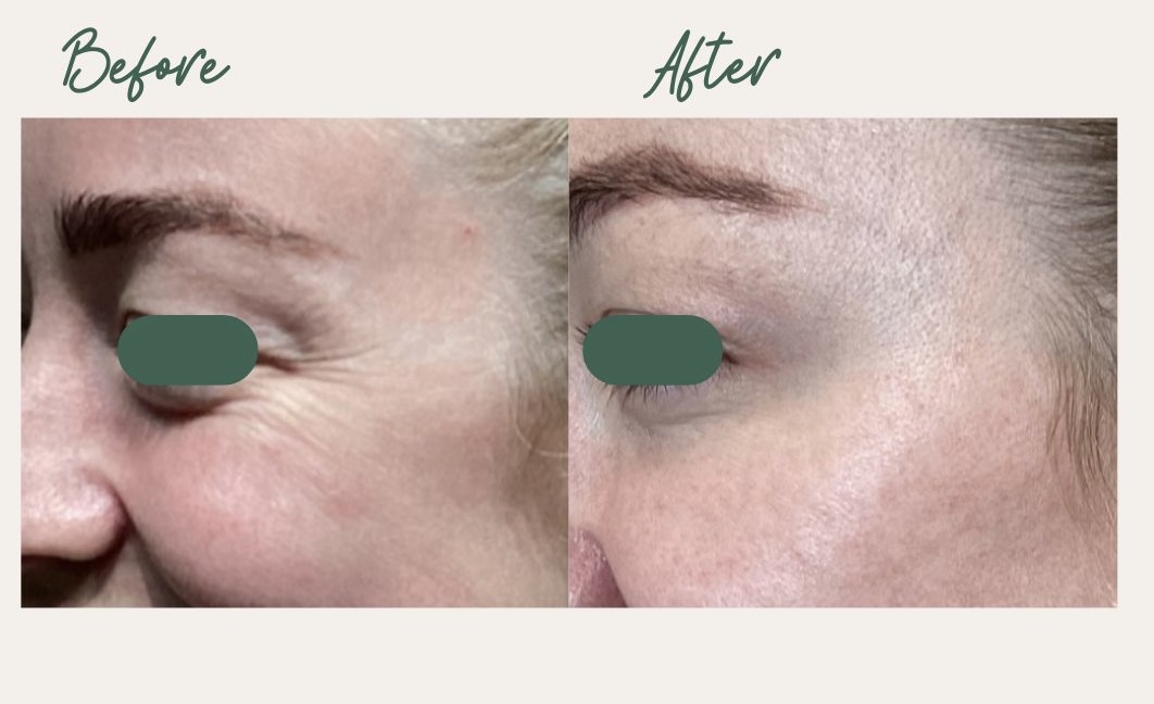 Crow's Feet Treatment