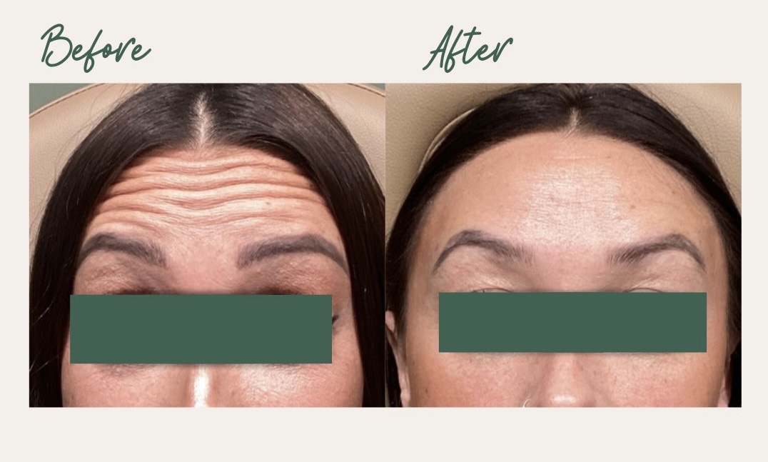 Forehead Lines Treatment