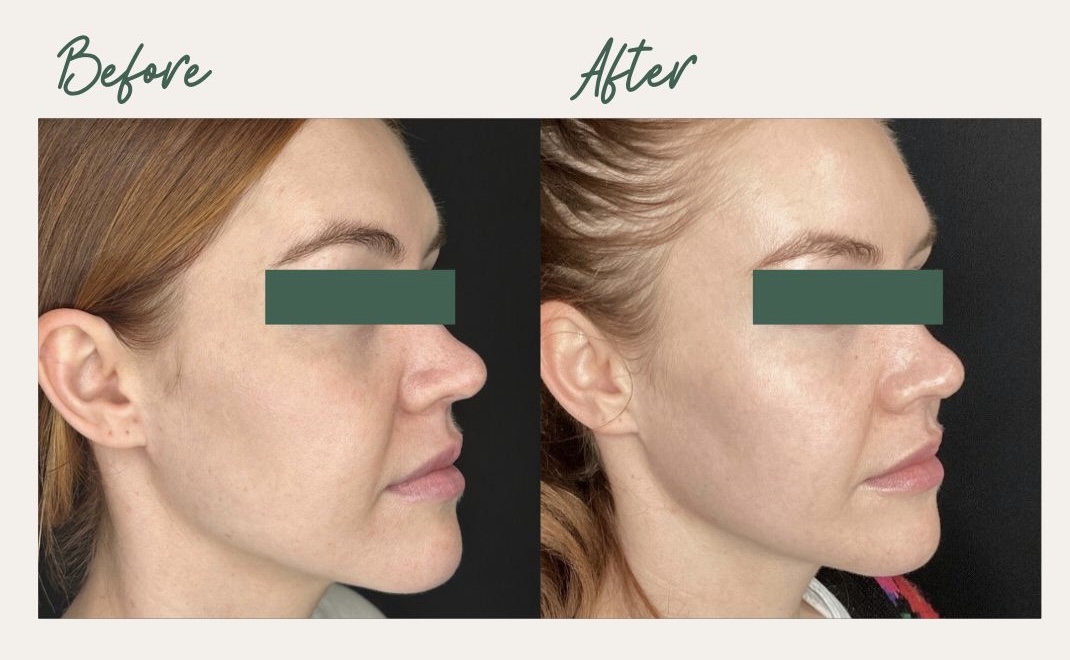 Improved Skin Texture and Tone