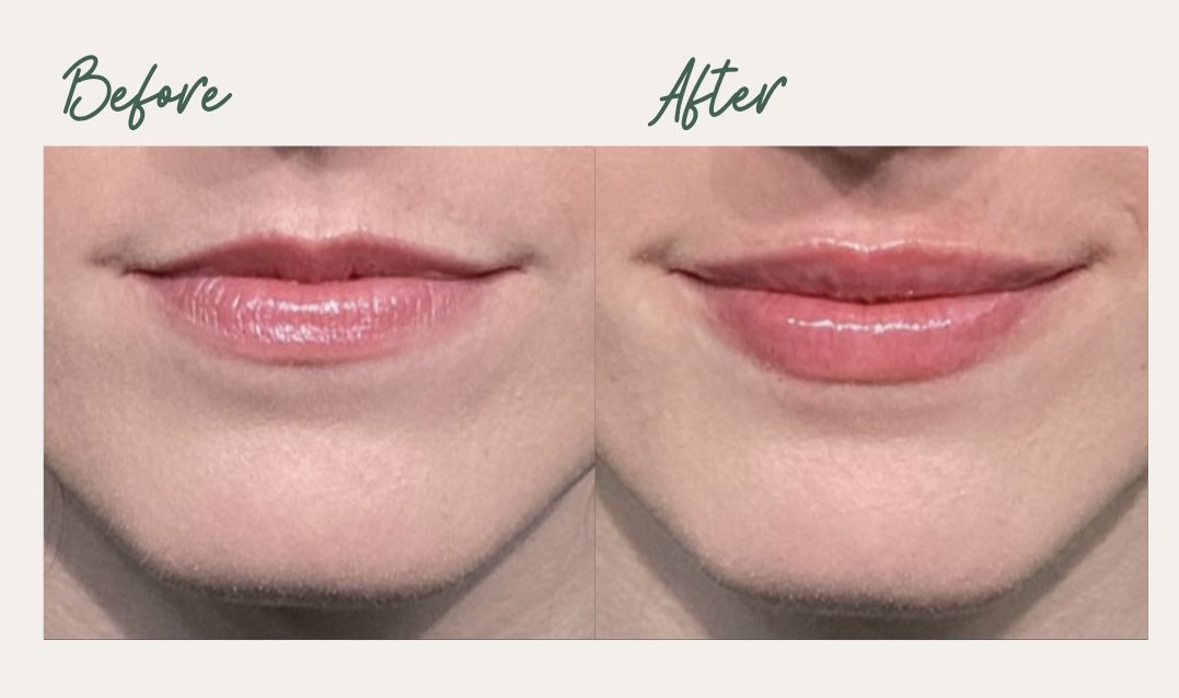 Lip Filler Result