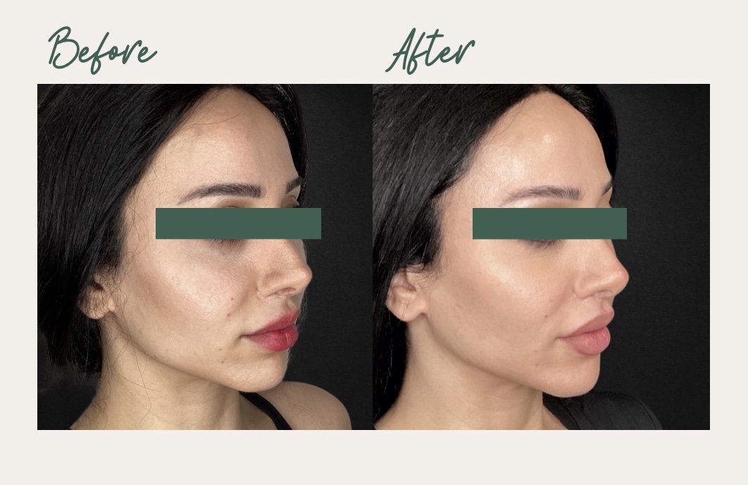 Full Face Sculptra Result