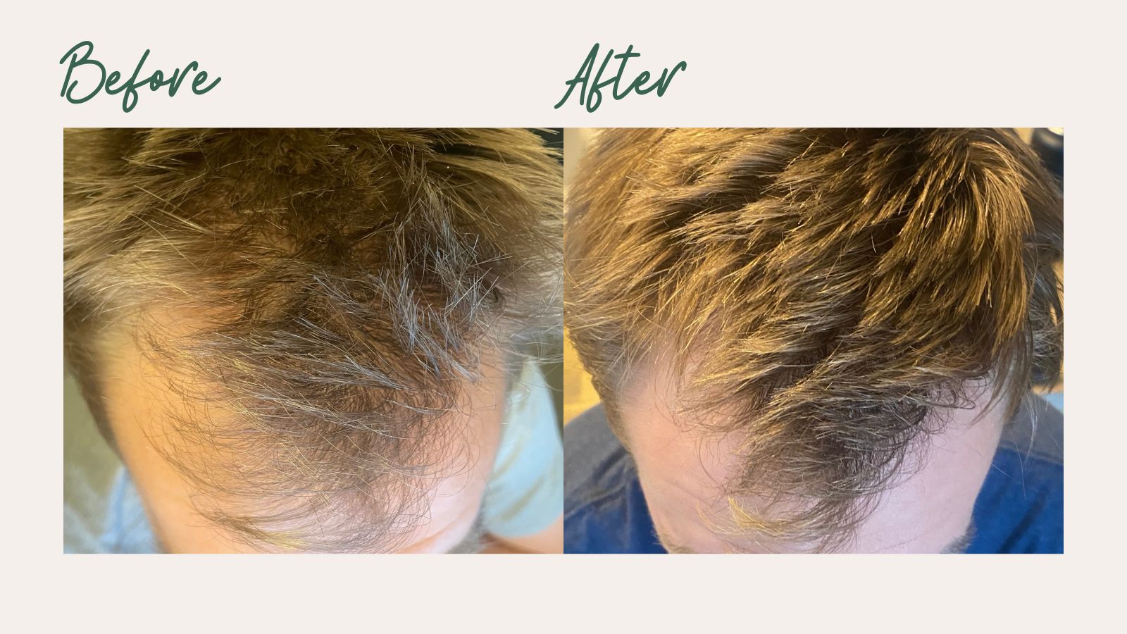 PRP Hair Restoration Result 1