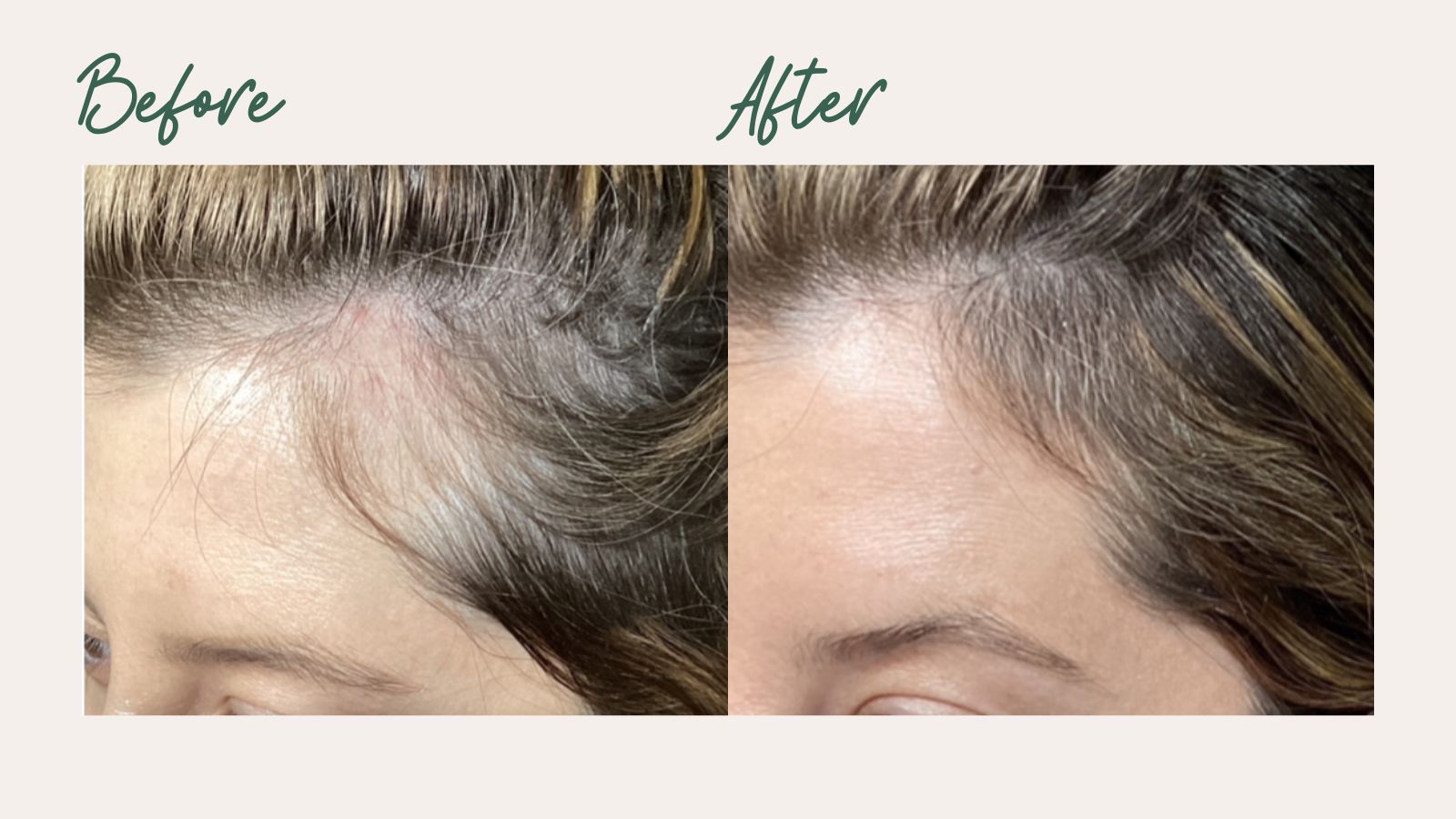 PRP Hair Restoration Result 4