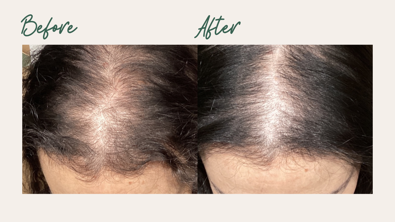 PRP Hair Restoration Result 5